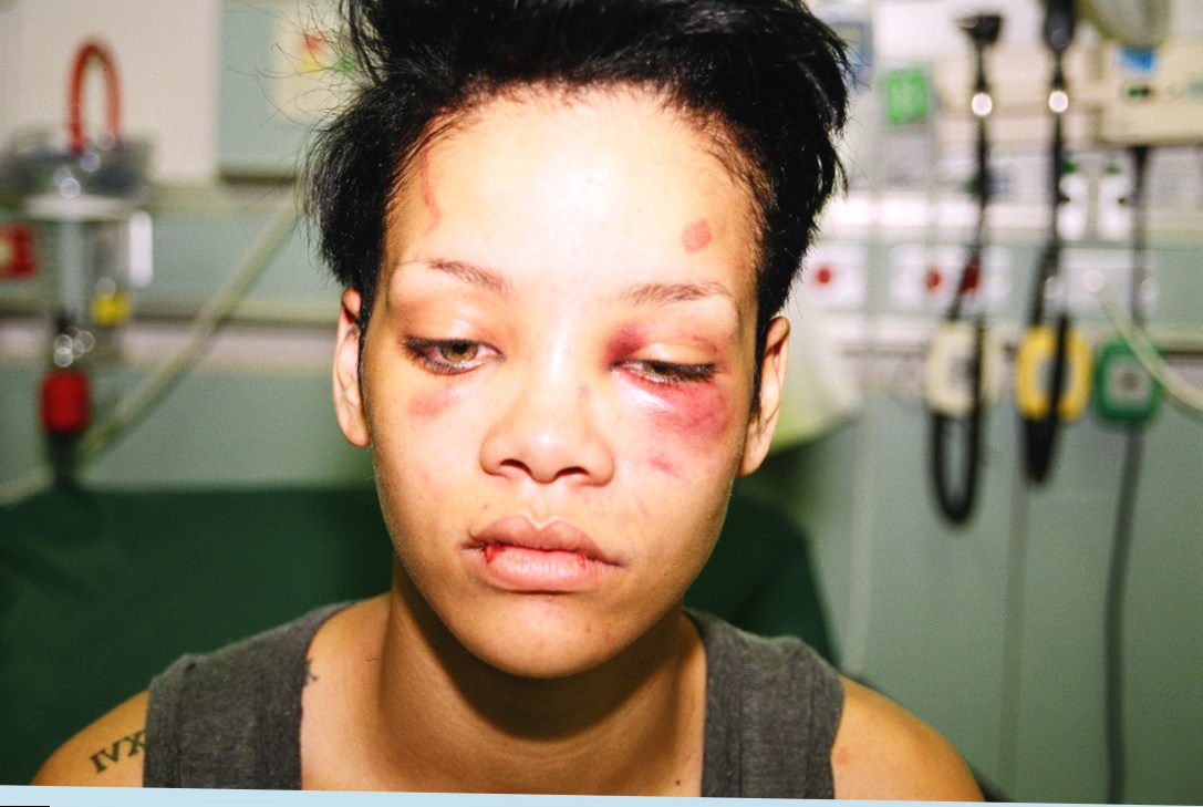 Pictures Of Rihanna After The Fight 11