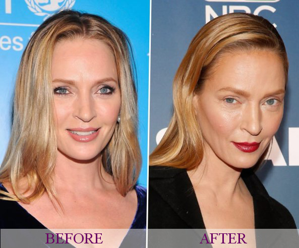 Celebrity Uma Thurman Plastic Surgery Photos Video