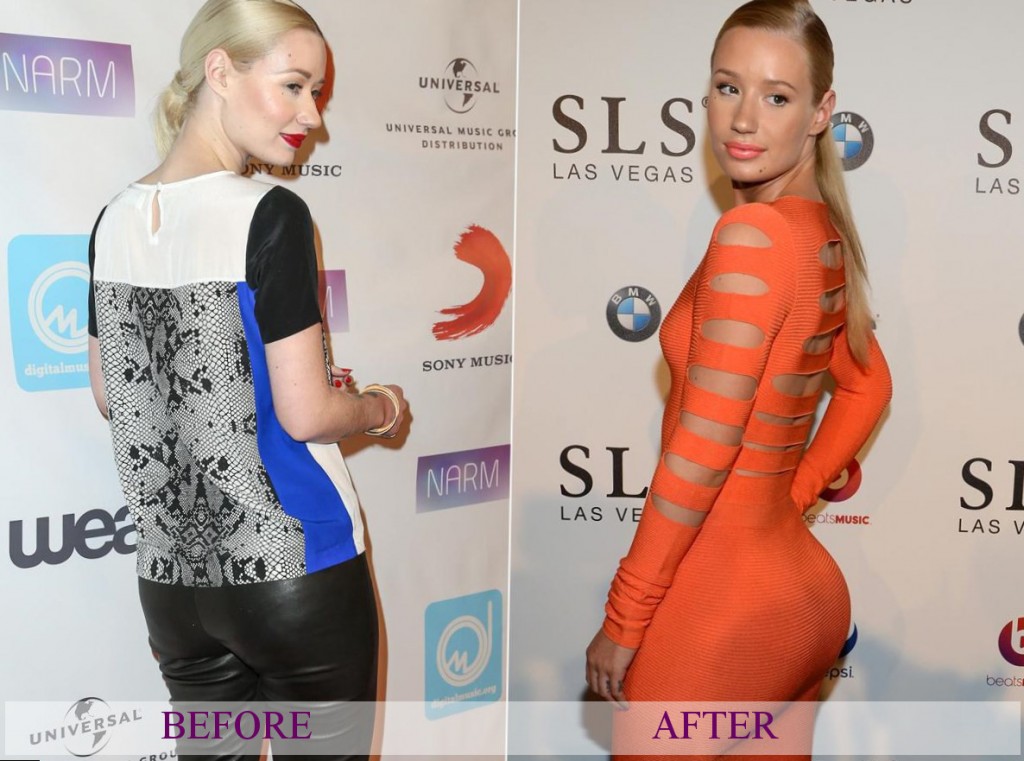 Iggy Azalea plastic surgery